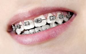 Sekutic Jaw orthopedics